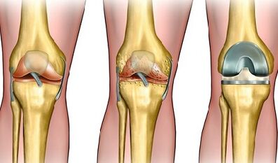 La etapa de desarrollo de la artrosis de la articulación de la rodilla