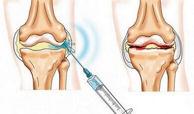 Restricciones de articulación de la rodilla para la artrosis