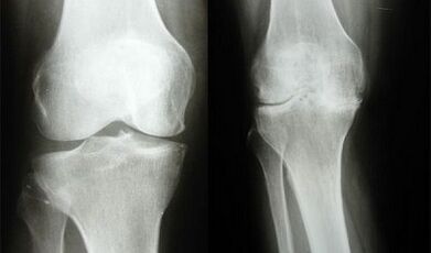 Un método de diagnóstico de rodilla