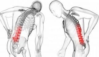 Hernia intervertebral complicaciones con la osteocondrosis