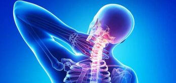 La causa de la osteocondrosis cervical
