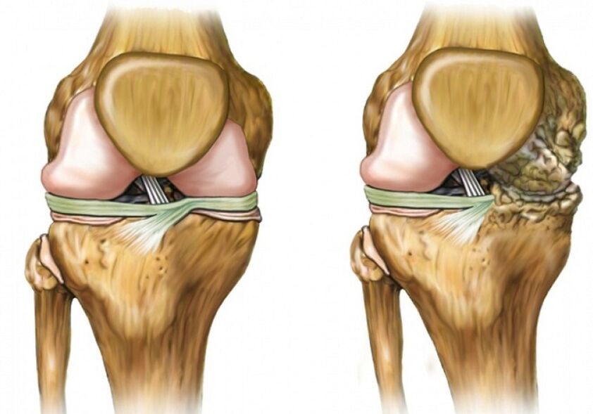 Artrosis de rodilla