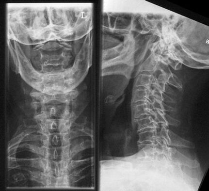 Cervical x -ray un método de diagnóstico de osteocondrosis