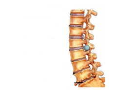 Daño a la columna con osteocondrosis cervical