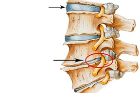 Espina normal y dañada con osteocondrosis cervical