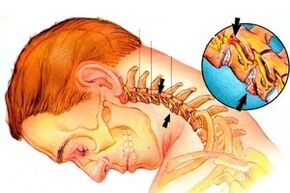 pellizcando los nervios en la columna con osteocondrosis cervical