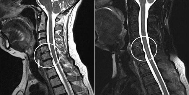 Resonancia magnética de la columna cervical