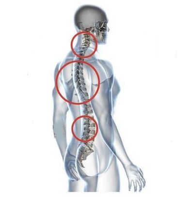 sitio de osteocondrosis de la columna
