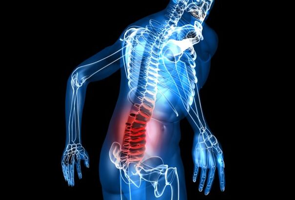¿Qué es la osteocondrosis lumbar